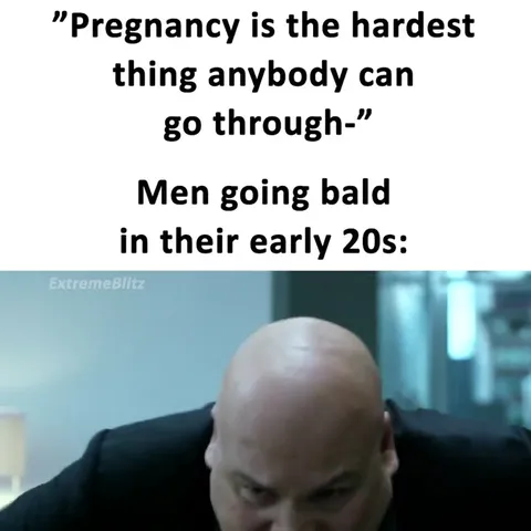 Men Going Bald in Their Early Twenties