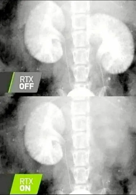 Kidney RTX On and Off