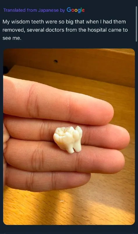 Wisdom Teeth Too Big