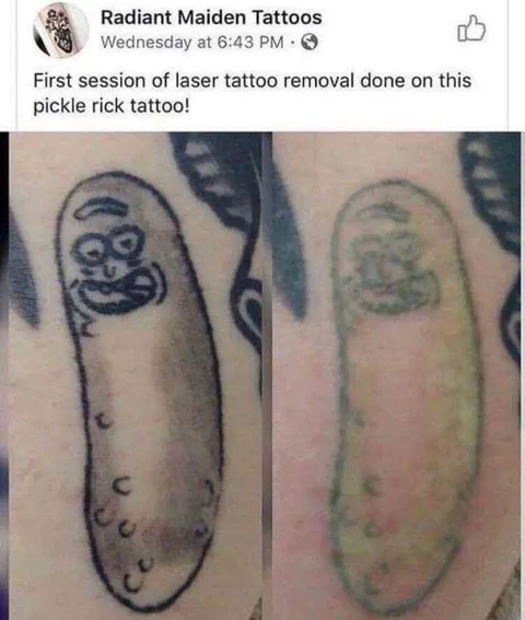 Pickle Rick Tattoo Removal