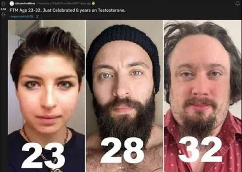 FTM Age Progression on Testosterone