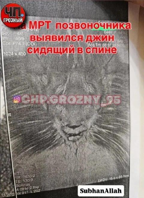 Джин в позвоночнике на МРТ