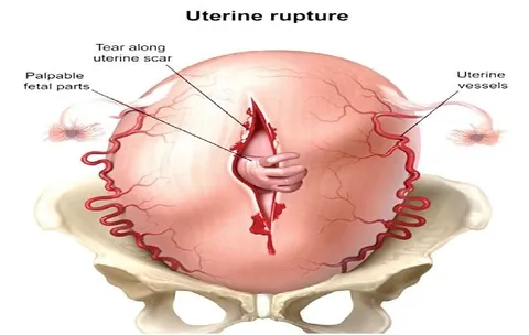 Uterine Rupture Diagram